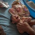 zika microcephaly baby